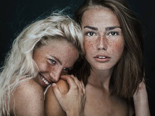 Freckles