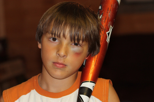blackeye
