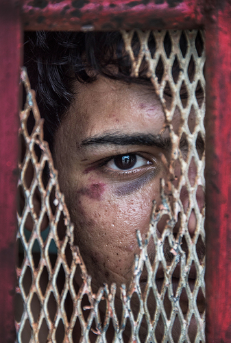 Beaten Asylum Seeker
