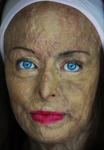Carol - Burns Survivor