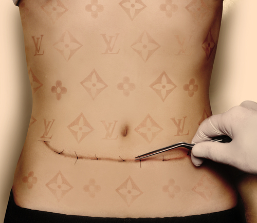 Louis V's Tummy Tuck