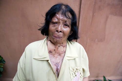 Acid Attack Survivor 