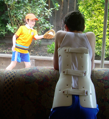 Juvenile Scoliosis Victim
