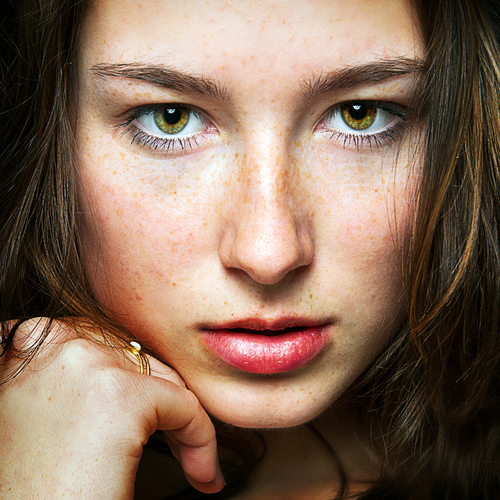 Freckles