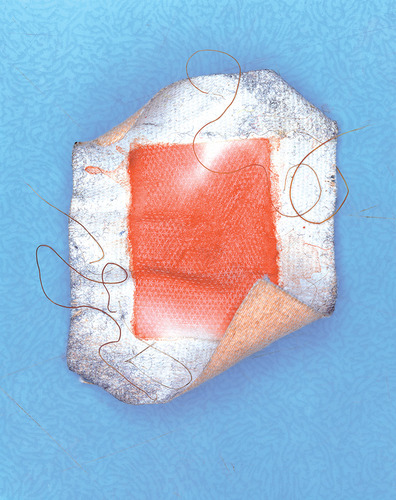 Plaster