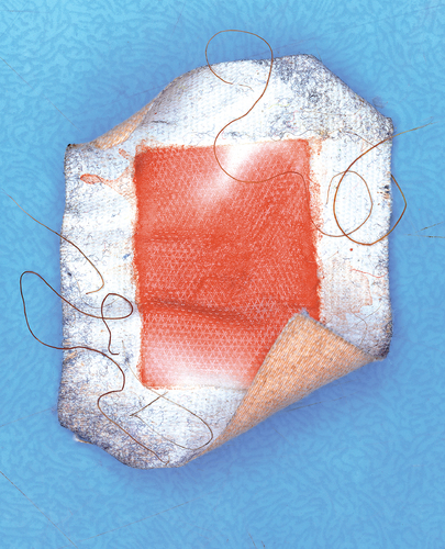 Plaster
