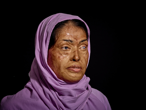 Acid Victim!