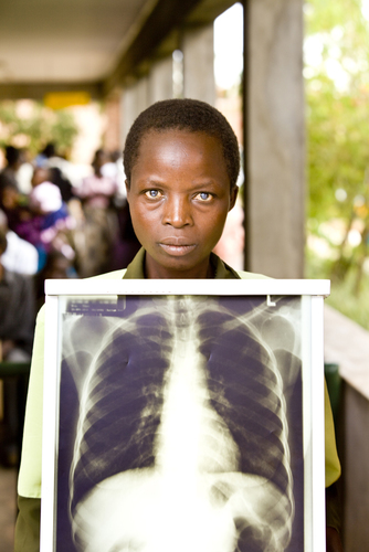 TB Patient Lilongwe, Malawi