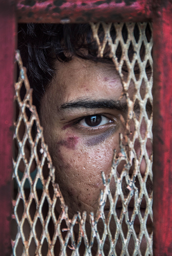 Manus - Beaten Asylum Seeker